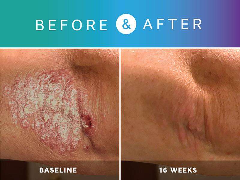 Prosoria Psoriasis Treatment System