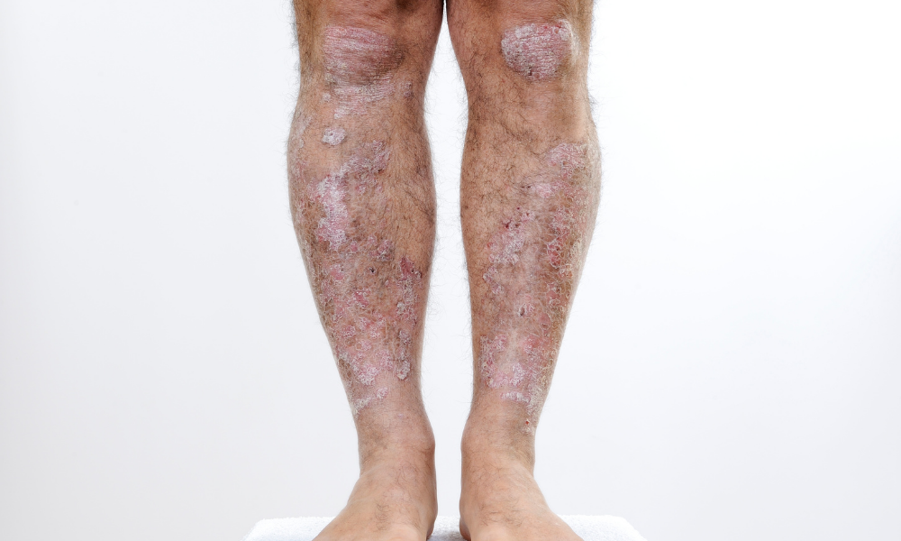 9 Best Ways to Speed Healing of Psoriasis on Legs