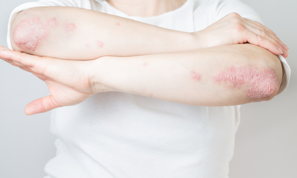 How to Control Psoriasis Flares on Knees and Elbows