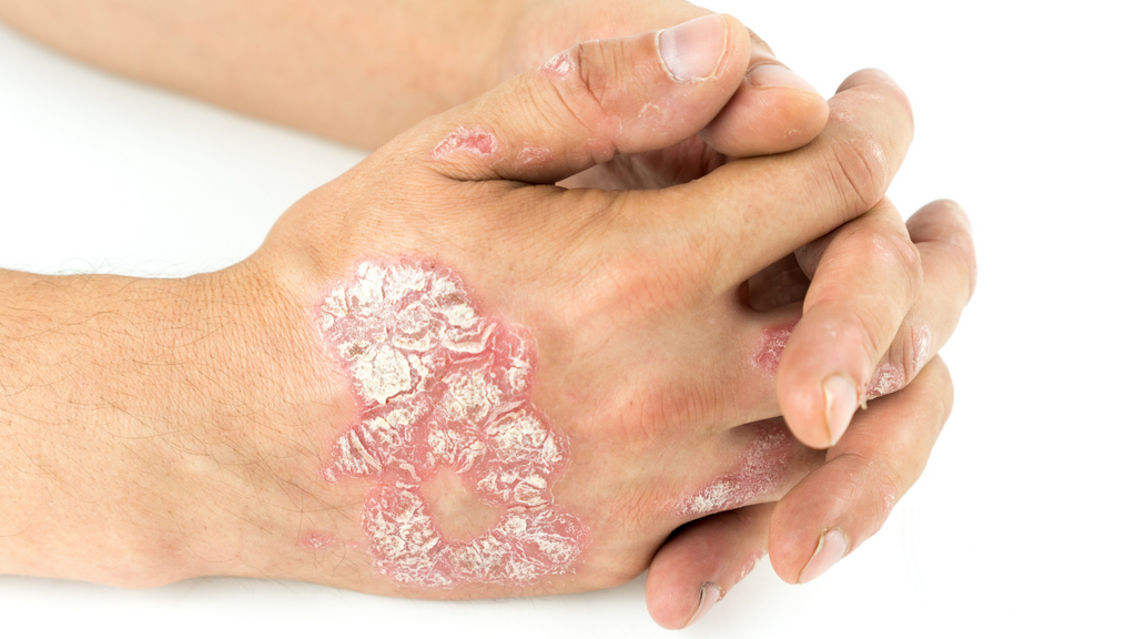 Top 9 Natural Remedies for Managing Hand Psoriasis