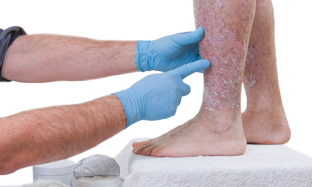 TREATING PSORIASIS: Why 12 Weeks is the Most Important Measure