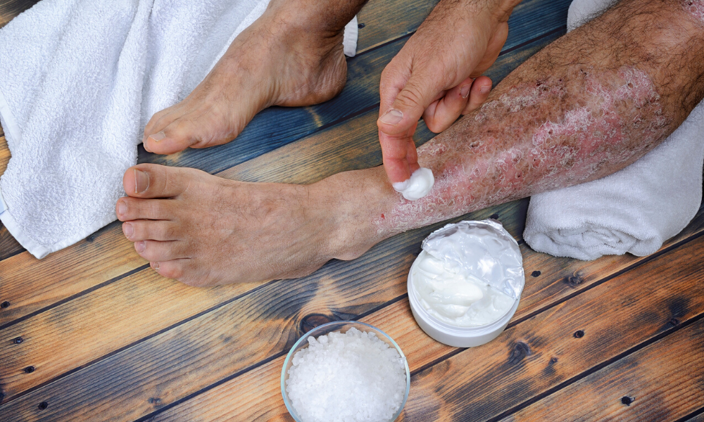 Natural Remedies for Psoriasis: Turmeric-vs-CBD