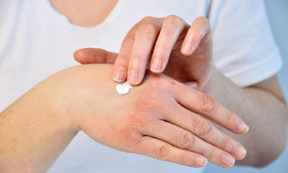 The Real Reason Over-the-Counter Psoriasis Creams Don't Have Lasting Results