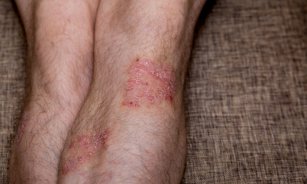 Psoriasis on the Legs: What You Need to Know