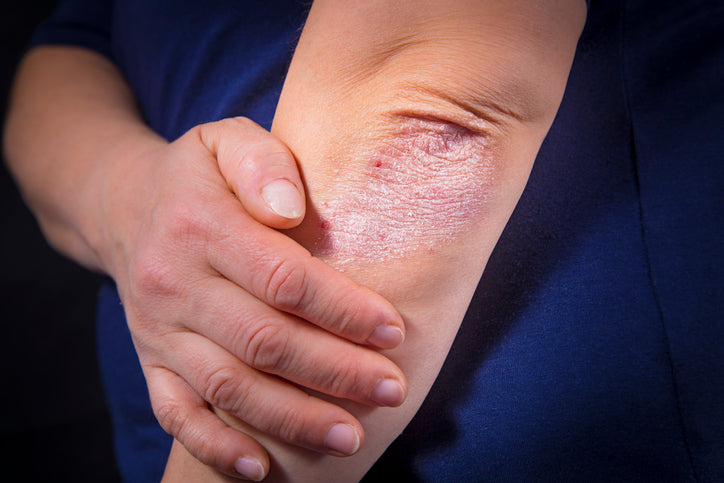 Comorbidities: Is Psoriasis Linked to Other Health Conditions?