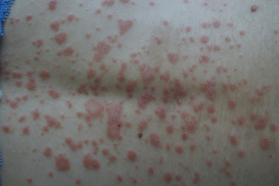 What Causes Guttate Psoriasis?