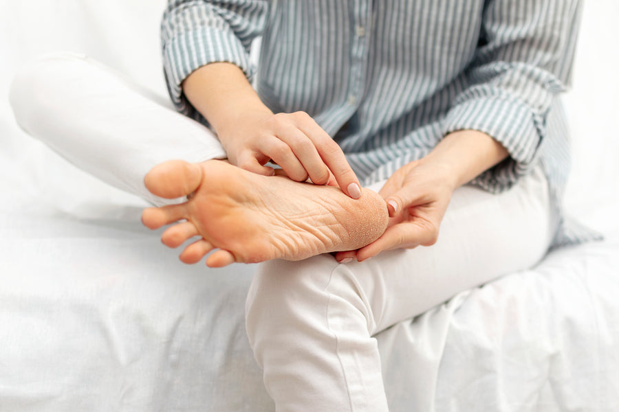6 Natural Remedies That Help Manage Psoriasis on the Feet