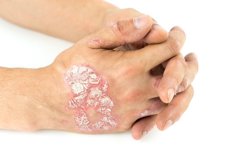 Sorry My Psoriasis Is Showing:  Why You Should Stop Apologizing