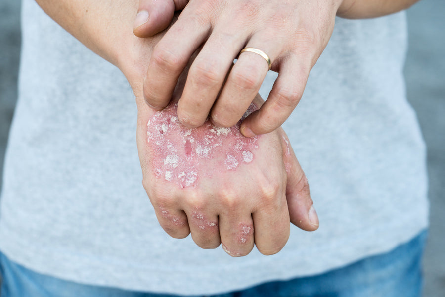 5 Most Common Psoriasis Triggers