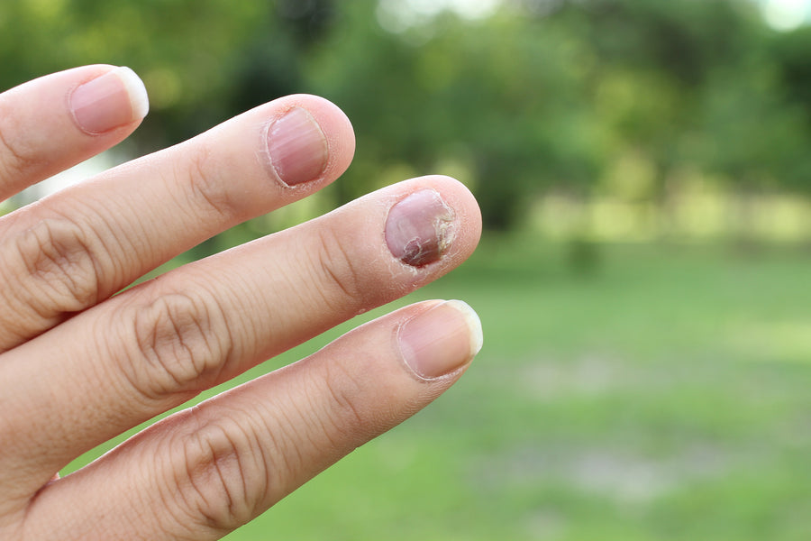 What Causes Nail Psoriasis?