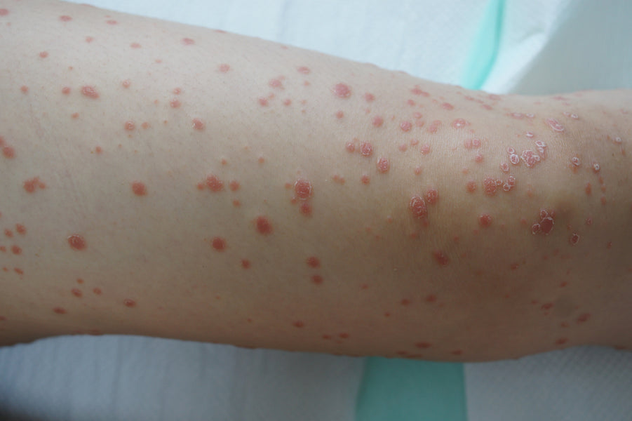 What Does Guttate Psoriasis Look Like?