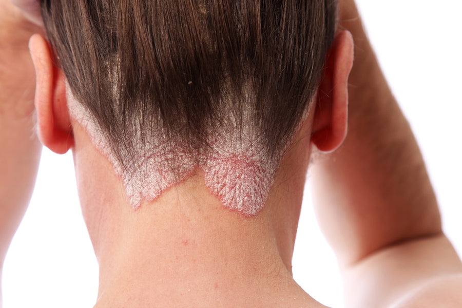 What Does Scalp Psoriasis Look Like?