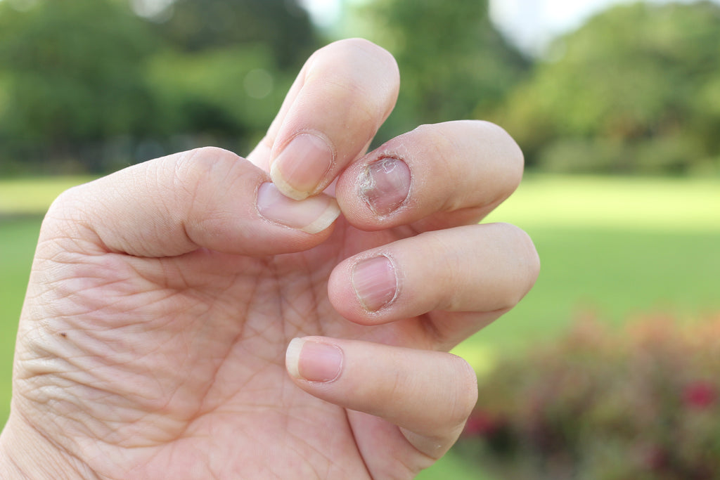 What is Nail Psoriasis?
